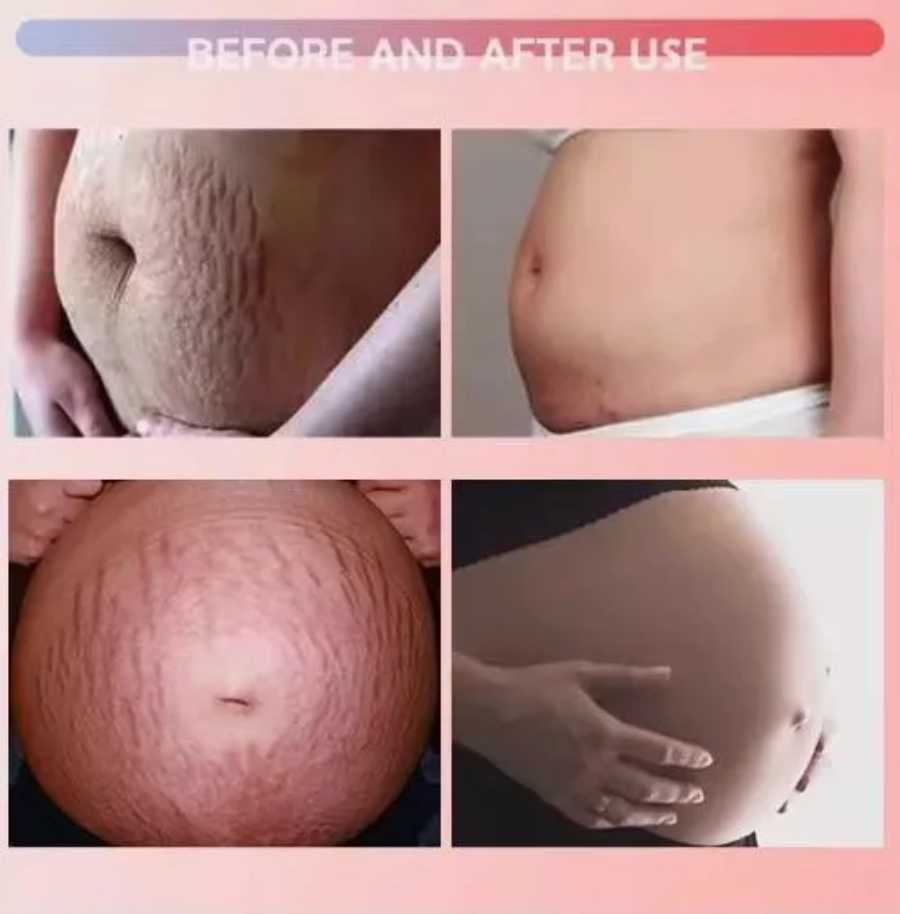 Snail Effect Stretch Mark Cream 100% Natural — Scars, Cellulite & Stretch Mark Care (230ml)
