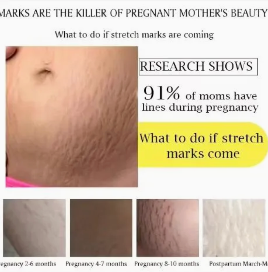 Snail Effect Stretch Mark Cream 100% Natural — Scars, Cellulite & Stretch Mark Care (230ml)